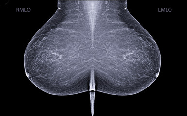 X-ray Digital Mammogram or mammography is x-ray image of the breast in women for screening  Breast...