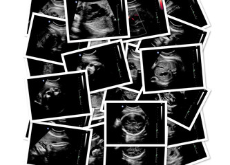 Pictures collection of baby ultrasound