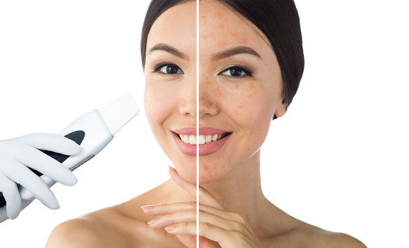 comparison face of beautiful woman with problem acne,blackhead, and after procedure ultrasound peeling skin are clean. Ultrasound Cavitation face peel skin before after