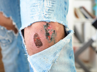 Wound on the knee torn jeans pants