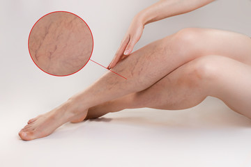 The concept of varicose disease and cosmetology. The woman gracefully crosses her legs with...