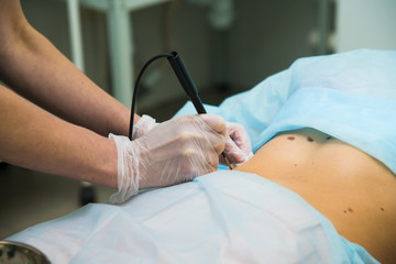 Removal of papillomas, moles with a laser instrument in medical conditions