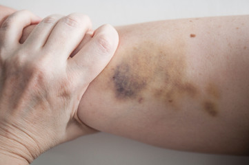 Fototapeta premium large hematoma on human arm