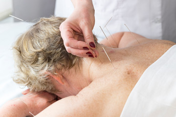 Elderly woman undergoing acupuncture procedure in a spa. - obrazy, fototapety, plakaty
