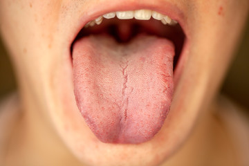protruding white plaque on tongue, closeup