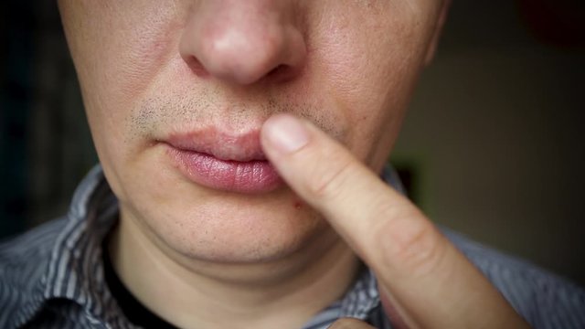 man lubricates with ointment red inflammation and herpes zoster virus on upper lip