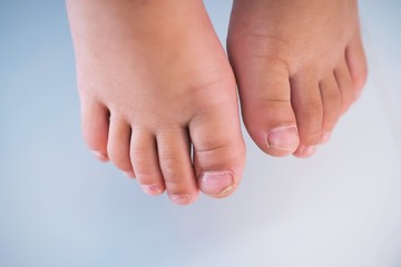 children foot with a cracked and peeling toe nail on the largest toe. Toenail Fungus