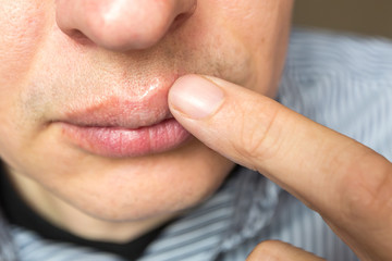 red inflammation and herpes zoster virus on upper male lip