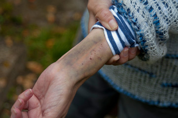 Deep bruise on a hand