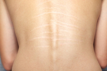 Close up view of the back with .stretch marks on the skin. The concept of impaired skin elasticity during puberty