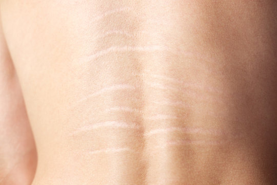 Close up view of the back with .stretch marks on the skin. The concept of impaired skin elasticity during puberty
