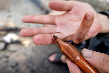 Medical care for cut. Man using pen iodine as antiseptic.