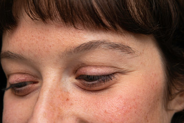 Woman face with enlarged pores, pigmentation spots close up