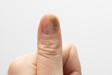 Nail fungal infection close up, thumb with subungual hemorrhage