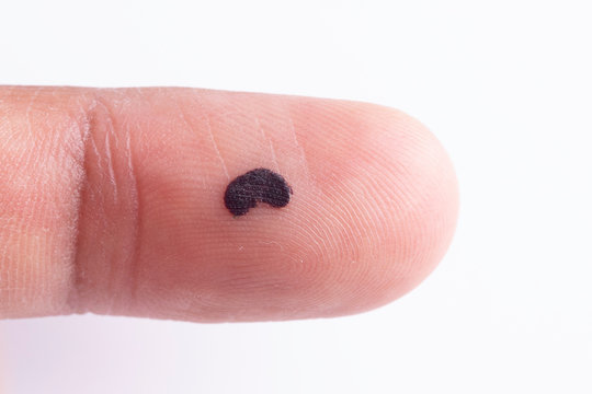 Papillary Finger Pattern And Birthmark Close Up