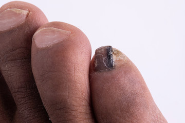 Toes fungal infection close up, fungus damaged toenail, deformed nail