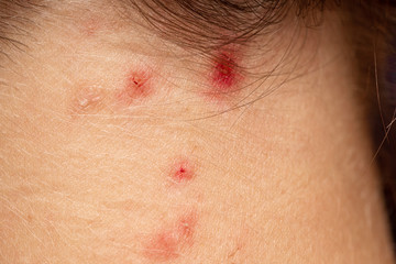 Squeezed pimples on female skin close up