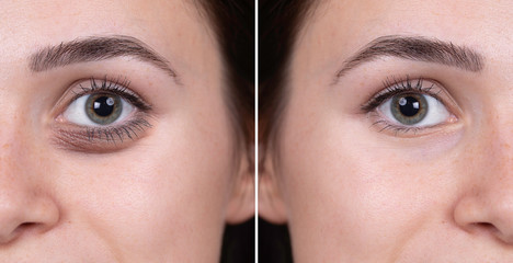 Eye bags before and after woman portrait comparison