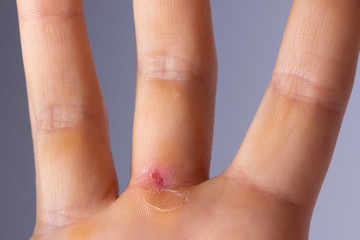 Wound, blister on hand palm close up