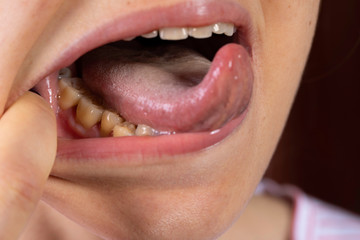 Person showing yellow teeth in open mouth close up
