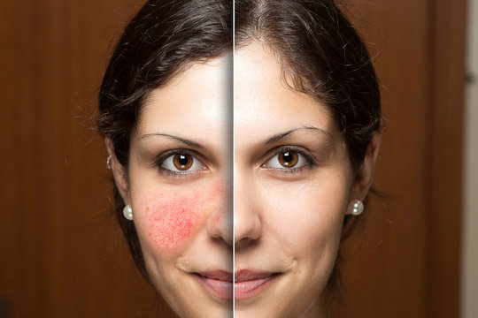Rosacea treatment, woman face before and after