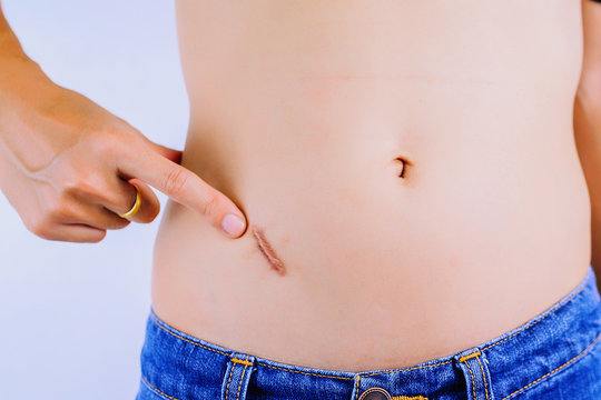 Pointing, Showing appendix scar at abdomen isolated on white background.