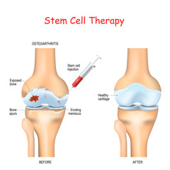 Stem cell therapy for pain in osteoarthritis © designua