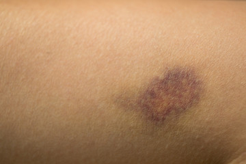 closeup of large red bruise on woman leg skin