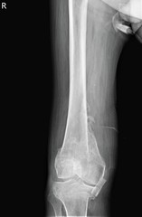 on radiography, a fracture of the right thigh in the lower part is determined