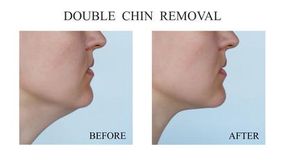 Woman double chin before and after procedures. Close up view - obrazy, fototapety, plakaty