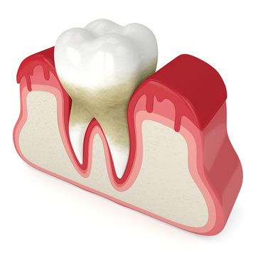 3d Render Of Tooth In Bleeding Gums