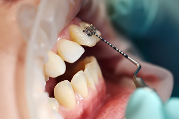Inspection Of Installation Of Braces By Dentist