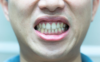 Fototapeta premium man grin a teeth AFTER a teeth cleaning Dental health care. He had my teeth cleaned