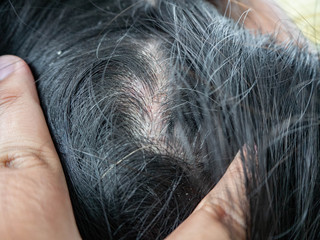 Scalp peeling,Woman is black hair,Irritation From shampoo,Closeup girl
