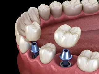 Premolar and Molar tooth crown installation over implant - concept. 3D illustration of human teeth and dentures