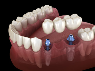 Dental bridge supported by implants. Medically accurate 3D illustration of human teeth and dentures concept