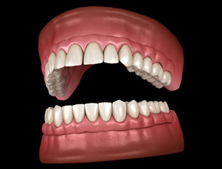 Naklejka premium Maxillary and Mandibular prosthesis with gum All on 4 system supported by implants. Medically accurate 3D illustration of human teeth and dentures