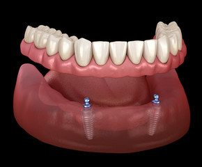 Mandibular removable prosthesis All on 2 system supported by implants with ball attachments. Medically accurate dental 3D illustration