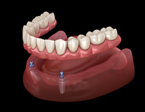 Mandibular removable prosthesis All on 2 system supported by implants with ball attachments. Medically accurate dental 3D illustration