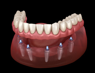 Mandibular prosthesis All on 6 system supported by implants. Medically accurate 3D illustration of human teeth and dentures concept