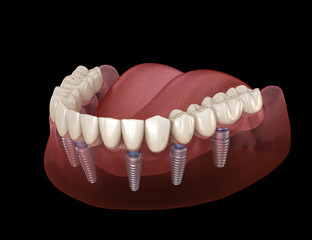 Mandibular prosthesis All on 6 system supported by implants. Medically accurate 3D illustration of human teeth and dentures concept