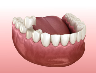 Preparated premolar tooth for dental crown placement. Medically accurate 3D illustration