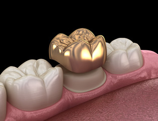 Golden crown molar tooth assembly process. Medically accurate 3D illustration of human teeth treatment