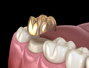 Golden crown molar tooth assembly process. Medically accurate 3D illustration of human teeth treatment