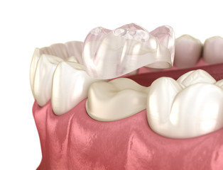 Preparated molar tooth for dental crown placement. Medically accurate 3D illustration