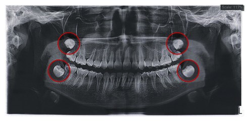 Dental x-ray for teeth surgery with the rudiments of wisdom teeth - https://t3.ftcdn.net/jpg/02/95/92/38/240_F_295923846_rSu4gWg6ucgjP8Dk7sXvaf1gxNG0EtHw.jpg