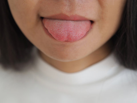 white tongue in asian woman caused by debris, bacteria and dead cells getting lodged on isolated white background use for health care concept.