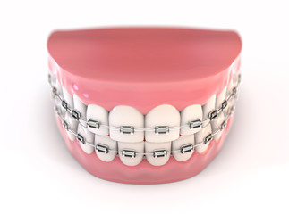 Fake Teeth Set With Braces