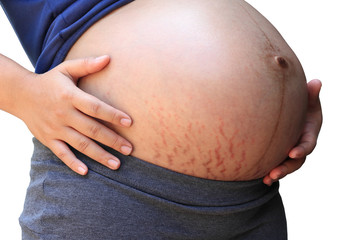 Pregnant women have allergic reactions and striped stomachs