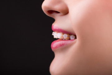 Braces. Beautiful Woman healthy smile close up. Closeup Ceramic Braces on Teeth. Beautiful Female...